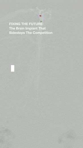 8.2K views · 23 reactions | This brain implant is lightyears ahead,...