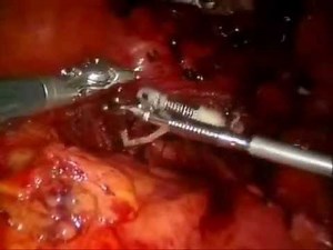 EndoGrab for Retraction During Robotic Hysterectomy • Video • MEDtube.net