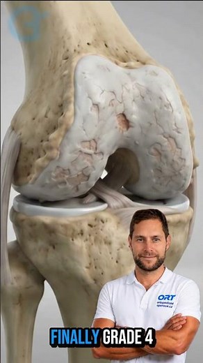 Knee Osteoarthritis Progression: From Grade I to Grade IV | 3D Animation