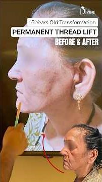 65-Year-Old Transformation | Permanent Thread Lift Before & After (4 Months) #shortsfeed