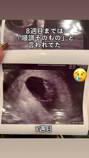 #妊娠記録 #プレママ #流産 #不妊 #不妊治療 #妊娠10週目 #心拍確認出来ない #心拍確認 #体外受精
