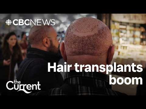 Why men are travelling to Turkey for hair transplants | The Current