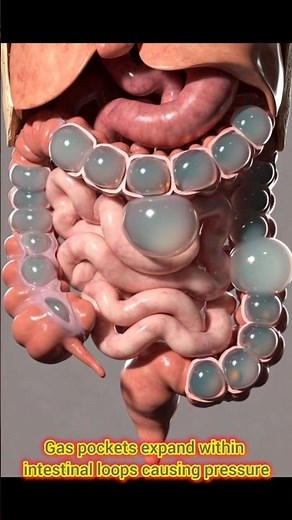Why Your Stomach Expands When Gas Builds Up Inside