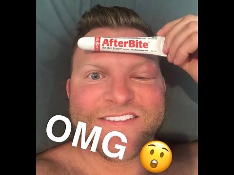 How To Treat A Mosquito Bug Bite On Eye (Face) (It Works!)