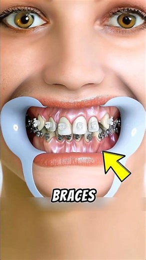 How Do Braces Really Work? 😬🦷