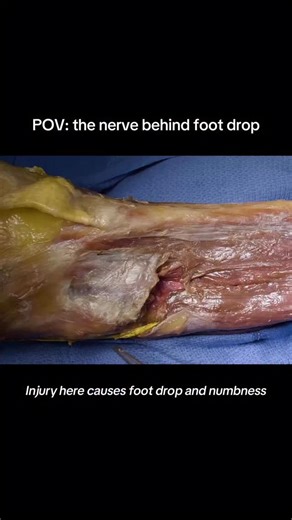 where foot drop comes from. the common fibular (peroneal) nerve wraps tightly around the outside of the knee. when it’s irritated or injured here, the muscles that lift the foot lose their signal. that’s why people develop foot drop: difficulty lifting the front of the foot while walking. seeing the anatomy makes the symptoms make sense. share this with someone who’s dealt with unexplained weakness, or a science friend who likes understanding why injuries happen. #anatomyexplained #seattlescienc