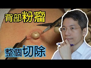 背部粉瘤 | 粉瘤取出 | 微創 | 表皮樣囊腫 | Dermatologist | Back epidermoid cyst | 角蛋白 | 皮膚活檢手術 | 皮膚專科