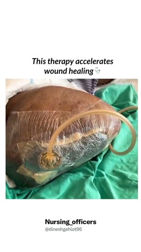 Negative Pressure Wound Therapy (NPWT) #wounddressing #nursingnow #nurse