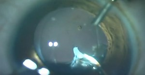 Persistent Fetal Vasculature - Eyetube