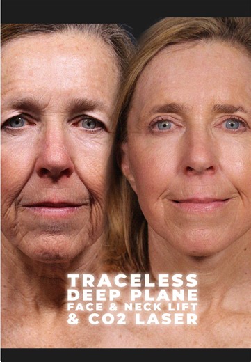 Transformative 5-Month Post-Op Face and Neck Lift Results