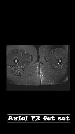 Perianal abscess