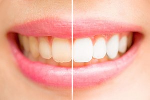 Top 8 Causes Of Teeth Discoloration