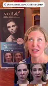 Laser-Coring after Removal of Botched Under eye Filler results & 3DMIRACL experience