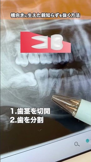 横向きに生えた親知らずの抜歯方法 #shorts #歯医者 #歯科口腔外科