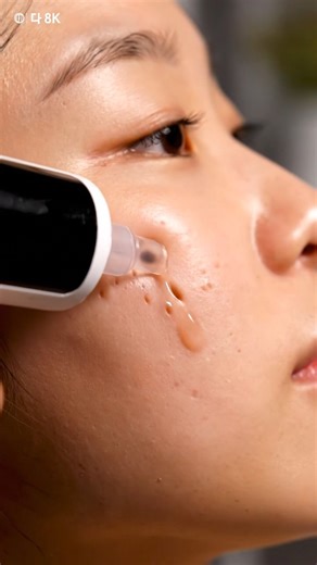 STUCK Cheek Blackhead Finally Removed | Satisfying Extraction