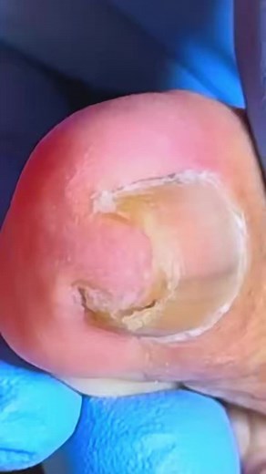 Doctors Couldn’t Believe What Was Inside This Toenail D1O0 Beautiful moments of care and relaxation through a gentle pedicure experience. Simple, clean, and satisfying. 🌿✨ Disclaimer: This video is for educational and relaxation purposes only. All content belongs to the respective owners, no copyright infringement is intended. | Toenail 23