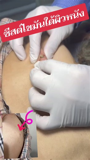 ซีสต์ไขมันใต้ผิวหนัง (Sebaceous Cyst/Epidermoid Cyst) คือก้อนนูนกลม ขอบเรียบ ผิวหนังปกติหรือมีรูเปิดเล็กๆ ตรงกลาง เกิดจากการอุดตันของต่อมไขมันหรือการสะสมของเคราติน มักโตช้าๆ ไม่ใช่เนื้อร้ายและส่วนใหญ่ไม่เจ็บ โดยมักพบตามใบหน้า คอ หลัง หากไม่ติดเชื้อ ไม่ต้องรักษา แต่ควรพบแพทย์ถ้าก้อนโตเร็ว เจ็บ หรืออักเสบแดง #ซีสต์ #amornclinic #สนใจทักข้อความเลยค่ะ