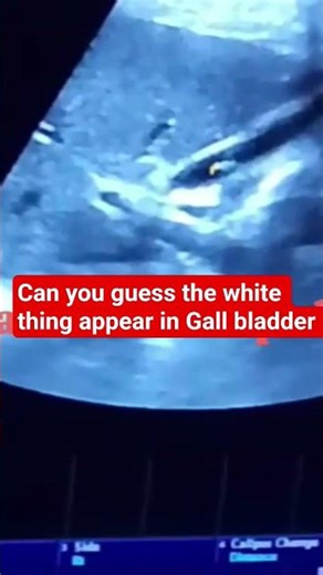 Detecting Gall bladder polyp on ultrasound, Quick, clear, and easy-to-understand explanation