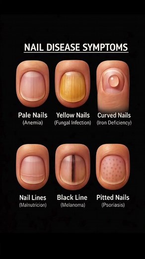 Nail Disease Symptoms You Should Never Ignore | Early Warning Signs in Nails