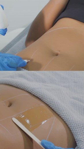 1.2K views | Loose skin post-pregnancy? ⁠ ⁠ Enjoy 50% off your first...