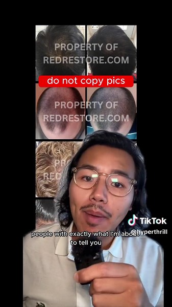 Stop Balding Naturally by Targeting DHT Effectively