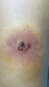 Nặn nhọt áp xe, mụn bé mà nhiều dịch mủ.