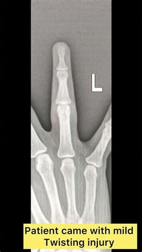 #handfracture#fingers#handinjuries#handsurgeon#fracturemanagement#fracturecare#fracture#clinic#care