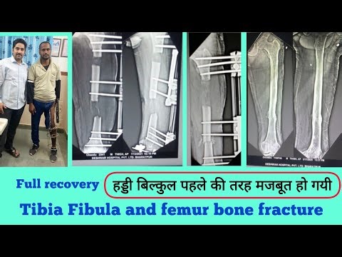 Full Recovery journey of Ilizarov and LRS surgery in Tibia fibula and femur bone non-union fracture