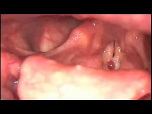 Hoarseness Caused by Red Vocal Fold Polyp • Video • MEDtube.net