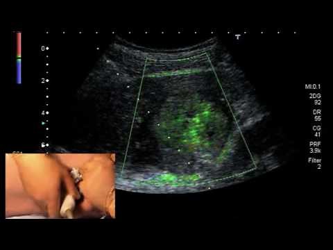 HCC PEI (percutaneous ethanol injection) ablation