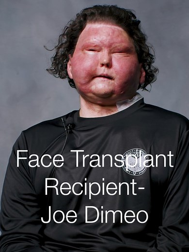 Joe Dimeo: A Face Transplant Journey of Resilience