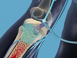 La perfusion intra osseuse : une voie d'abord à redécouvrir - Actusoins
