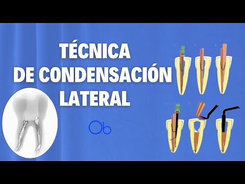 Lateral Condensation Technique 🦷 in Endodontics