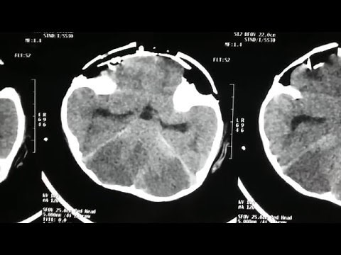 Cerebral edema on ct brain