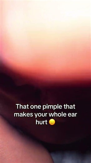 That one pimple that makes your whole ear hurt
