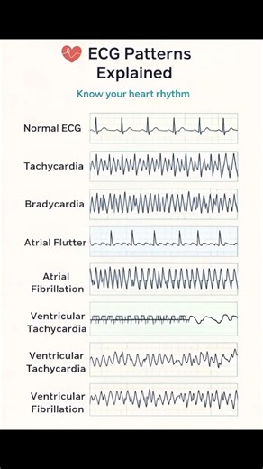 ECG Patterns Explained 🫀🩺 #medico #ecg