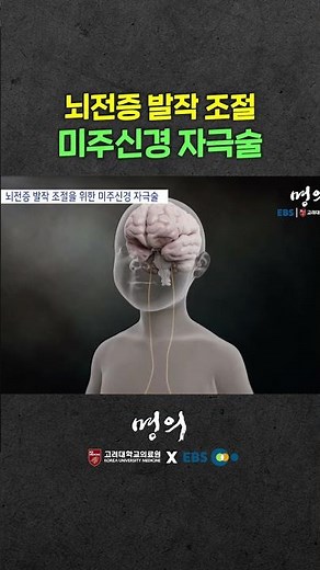 경련 줄어드는 미주신경 자극술