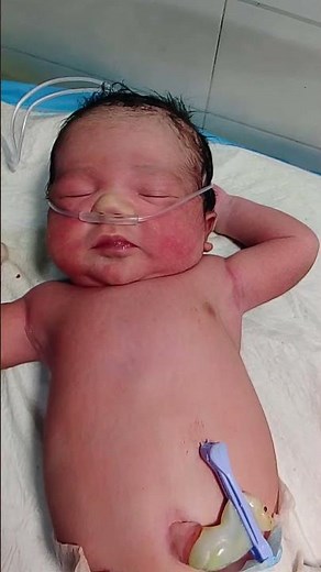 Grunting is a sign of breathing difficulty in newborns and needs close NICU observation.