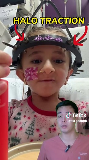 How to operate SCOLIOSIS | Surge On *Disclaimer: for educational purposes only* #scoliosis #ScoliosisHalo #HaloRod #ScoliosisOperation #SurgeOnPh #storytime #satisfying #surgerytiktok #FYP #foryoupage #surgery #surgeontiktok #medicaloperation #health