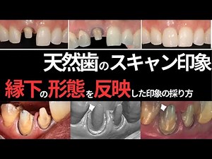 『デジ校⑤』 天然歯のスキャン印象のコツとは？〜エマージェンシープロファイルの再現方法