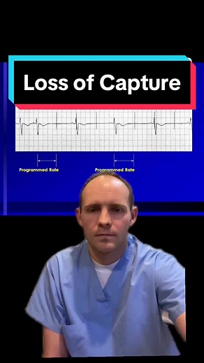 #greenscreen pacemaker ecg strip! #pacemaker #fyp #ecg #nursingstudent #ekg #ecginterpretation #nurse