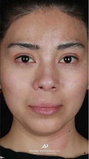 Cleft Rhinoplasty with Rib Graft | Scarless Closed Technique | 6 Months