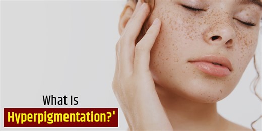 Dark Patches On Skin? It Could Be Hyperpigmentation. Know What It Is