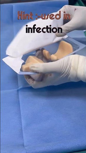 Cement spacer is used in stage 1 of revision knee replacement #jointreconstruction #arthroplasty