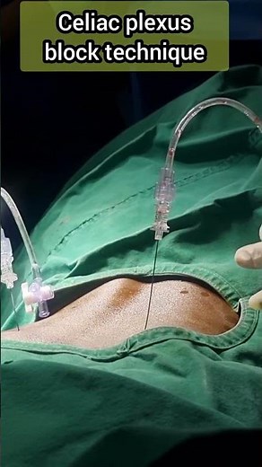 Celiac plexus block technique