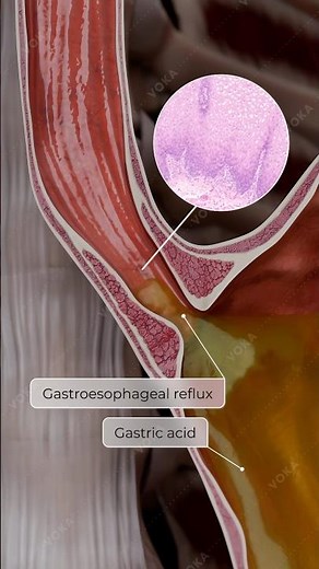 Barrett’s Esophagus: The Hidden Risk of Chronic GERD | 3D Animation Explained