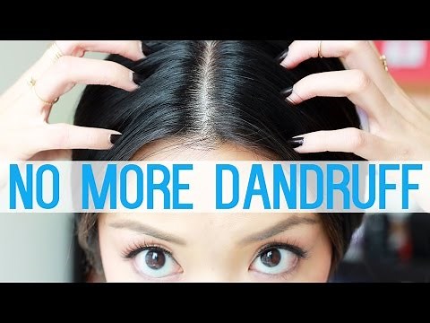 HOW TO: Get Rid Of Dandruff