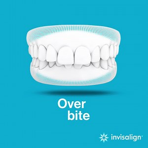 47K views · 775 reactions | Find a doctor that will custom fit you for an Invisalign® clear aligner today. | Invisalign | Facebook