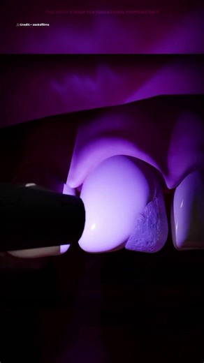 How Dentists Fix a Chipped Tooth 🦷🧑‍⚕️