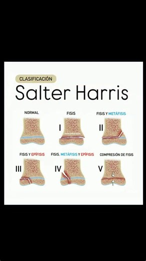 Dr. Rohit Kumar (PT) on Instagram: "The Salter-Harris classification: It is a system used to classify bone fractures in children, hu specifically those that affect the growth plate (physis), which is the cartilage area at the end of the long bones where bone growth occurs."